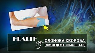 «Health - гід». Слонова хвороба лімфедема лімфостаз