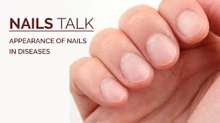 How Do Nails Help in Diagnosing Systemic Disease ? Nail Abnormalities in Systemic Diseases