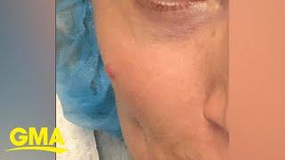 Woman diagnosed with cancer after finding bump on face l GMA