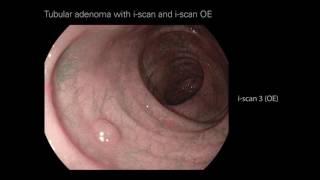 Tubular Adenoma with i-scan and i-scan OE 1 - LGI