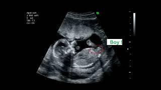 15 weeks active fetus  Its a Boy   By CRL  Ultrasound Case