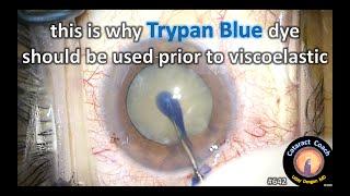 This is why trypan blue dye is best used before viscoelastic in Cataract Surgery