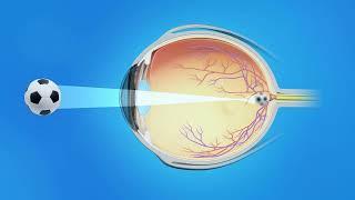 Nearsightedness Myopia