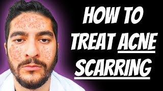 How To Treat Acne Scarring 2024