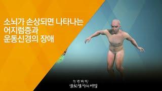 소뇌가 손상되면 나타나는 어지럼증과 운동신경의 장애 - 2018.6.27_652회 방송 아무도 모르는 고통 나만의 어지럼증