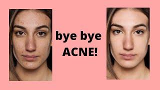 HOW TO EDIT OUT ACNE LIKE A PRO  - How to edit out acne from your IPHONE