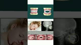 Effects of Thumb Sucking Habit  Child Dentist  Patient Education Animation