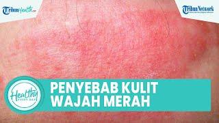 Penyebab Kulit Wajah Merah Meradang akibat Rosacea Begini Cara Atasinya