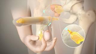 Penile Prosthesis Animation - Utah Mens Health