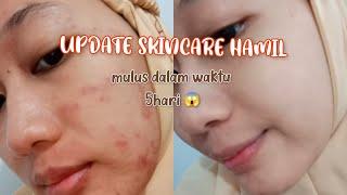 SKINCARE HAMIL  ATASI BRUNTUSAN SAAT HAMIL #kulitberjerawat #skincarehamil