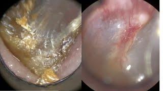 141 - Very Impacted & Stubborn Dead Skin Plugs Extracted from Ear using WAXscope®️