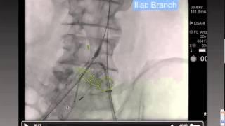 Magellan Case Iliac Aneurysm Embolization Houston Methodist