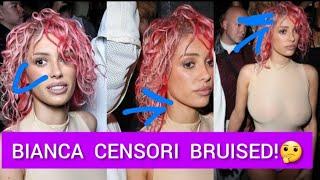 BIANCA CENSORI SPOTTED WITH A BRUISED FACE FOLLOWING KANYE WESTS S*XUAL HAR*SSMENT LAWSUIT