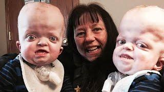 Grandma Adopts Twins With Rare Genetic Disease Says Shes Privileged