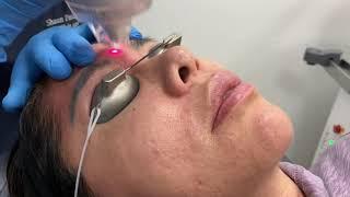 LaseMD Ultra laser treatment for hyperpigmentation and skin rejuvenation in Miami FL by Dr. Patel