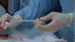 Initial Placement of the EndoVive™ Safety Percutaneous Endoscopic Gastrostomy PEG Tube