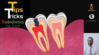 Essential tips and tricks in Endodontics  Part 2  Tips 6-10