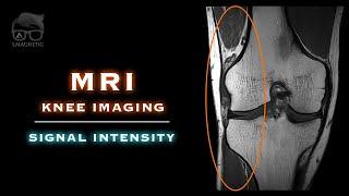 MRI – KNEE – SIGNAL INTENSITY