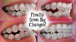 Wearing a rubber band 8 month braces update