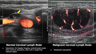 Cervical Lymph Nodes Ultrasound Normal Vs Abnormal Images  Reactive & Malignant Neck Nodes USG Scan