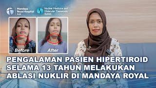 Testimoni Pasien Hipertiroid Selama 13 Tahun Sembuh Dengan Terapi Ablasi Nuklir