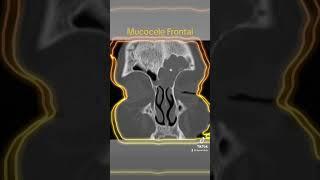 Mucocele Frontal