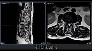 تفسير أشعة رنين اسفل الظهر  رجل عمر 55 سنة يعاني من ألم وخدر  الأرجل وصعوبة المشي