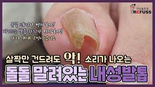 살짝만 건드려도 악 소리가 나오는 고통스러운 내성발톱 - ingrown toenail  tinea unguium