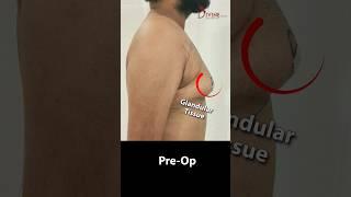 Gynecomastia Grade 3B 360° Surgery Result  Before and After Grade 3B #shorts