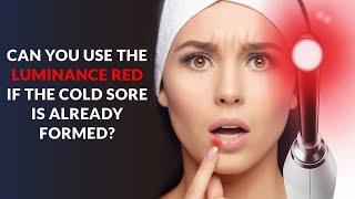 Can You Use the Luminance RED if the Cold Sore is Already Formed? Cold Sore Laser Treatment