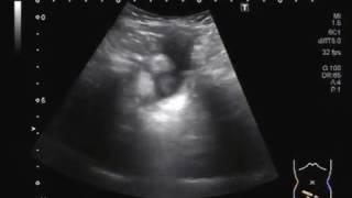 Ultrasound Video showing Hepatomegaly with liver approaching  kissing  the spleen.