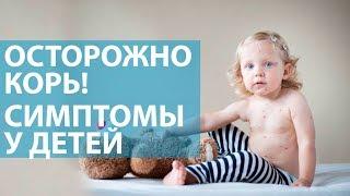 Симптомы кори Поможет ли прививка от кори?