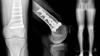 Lateral Meniscal Allograft Transplantation With Distal Femoral Osteotomy and Fresh OATS
