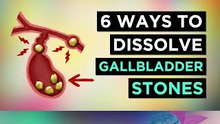 How To Dissolve Gallstones Causes & Treatment