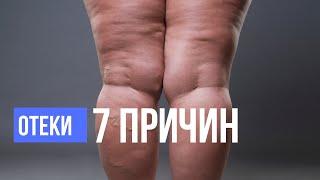 7 причин отеков. Как избавиться от отеков. Отечный синдром или лишний вес