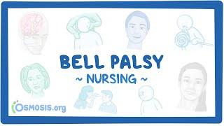 Bell Palsy Clinical Nursing Care