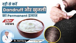 दही से Dandruff कैसे हटाए -  How To Use Dahi For Dandruff  Remove Dandruff