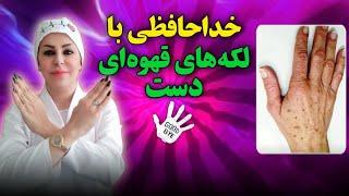 خداحافظی با لکه های قهوه ای  درمان خانگی لکه قهوه ای دست