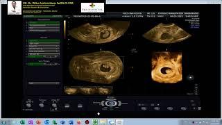 KEHAMILAN EKTOPIK DI LUAR RAHIM - JANIN HIDUP Dr Wiku Andonotopo