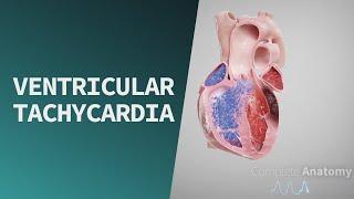 Ventricular Tachycardia