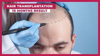 Sapphire Fue Hair Transplant 10 Months Results