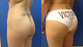 Buttock Augmentation Before & After Brazilian Butt Lift