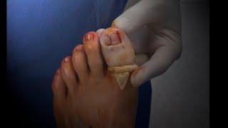 Ingrown Toenail Procedures Winograd Technique & Partial Nail Avulsion with Phenolisation.