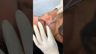 Remoção de Microdermal ️ #piercing #bodypiercing