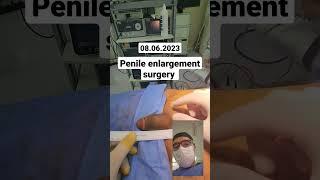 Penil enlargement surgery by Dr Araz Bayramov #andrologist #andrologist #urologist #dr.arazbayramov