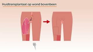 Genitale chirurgie vermannelijking phalloplastiek