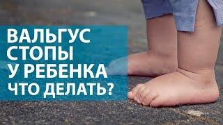 Вальгус стопы у ребенка Что делать? ОН КЛИНИК Бейби