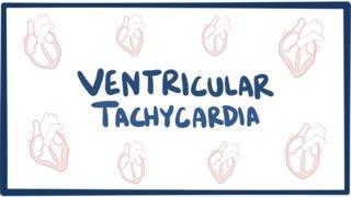 Ventricular tachycardia VT - causes symptoms diagnosis treatment & pathology