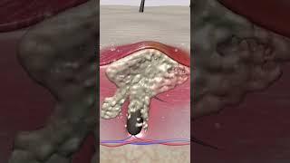 Blackheads Whiteheads Removal  Pimple Removal  How To Remove Blackheads  How To Remove Whiteheads