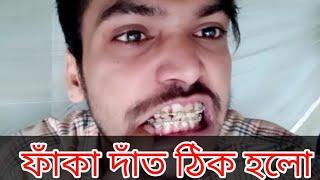 ফাঁকা দাঁতের চিকিৎসা  Faka dat thik korar upay  My Braces Journey Prasenjit Xkr